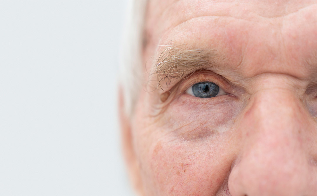 9 FACTS ABOUT MACULAR HOLE THAT YOU DON’T KNOW BUT IMPORTANT FOR YOU (ESPECIALLY IF YOU HAVE ELDERLY PARENTS)
