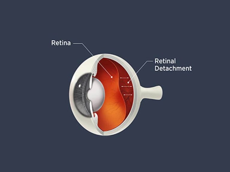 WHY YOU SHOULDN’T DELAY YOUR RETINAL SURGERY