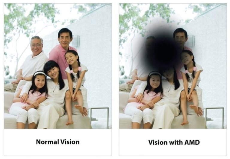 Age-related Macular Degeneration (AMD): What You Need to Know