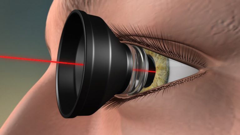 Understanding Polypoidal Choroidal Vasculopathy (PCV)