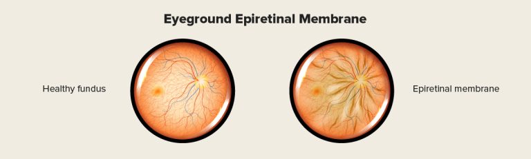 Understanding Epiretinal Membrane: A Comprehensive Guide