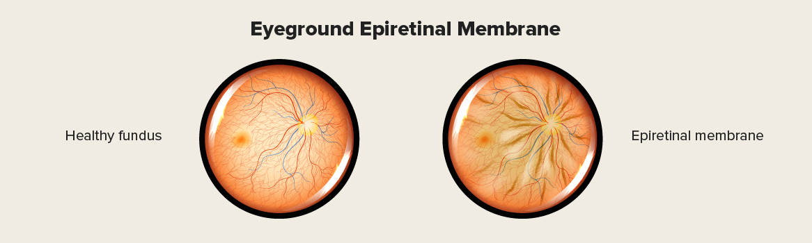 Understanding Epiretinal Membrane: A Comprehensive Guide