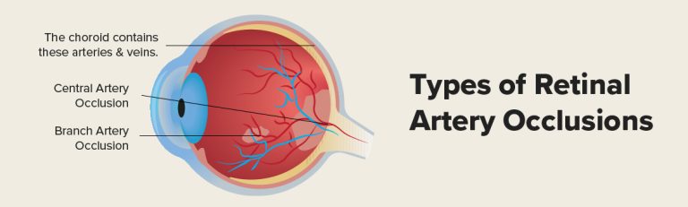 Retinal Artery Occlusion (Eye stroke): What You Need to Know