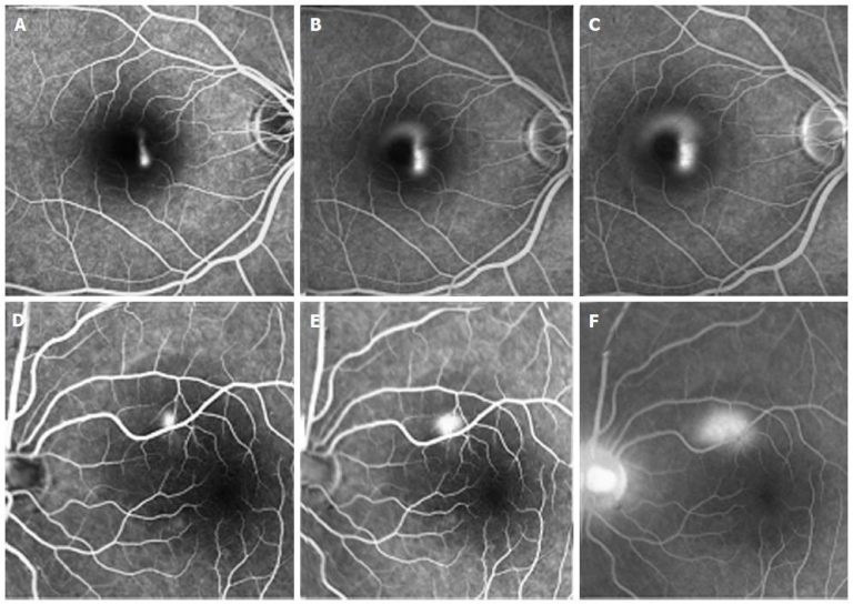 Central Serous Retinopathy: Essential Insights to Safeguard Your Vision