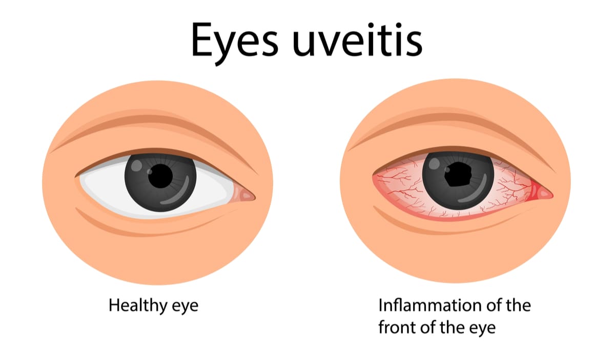 Uveitis : Inflammation Inside the Eye