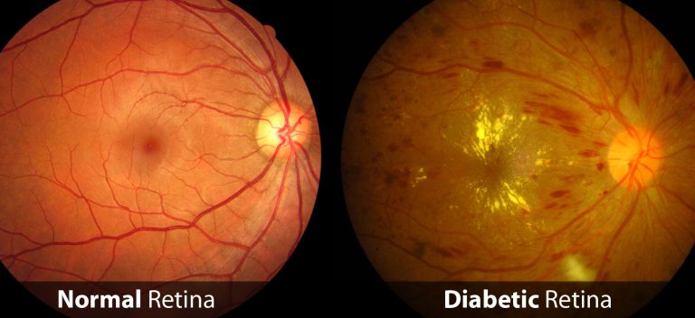 Understanding Diabetic Retinopathy (Diabetic Eye): A Simple Guide for Patients