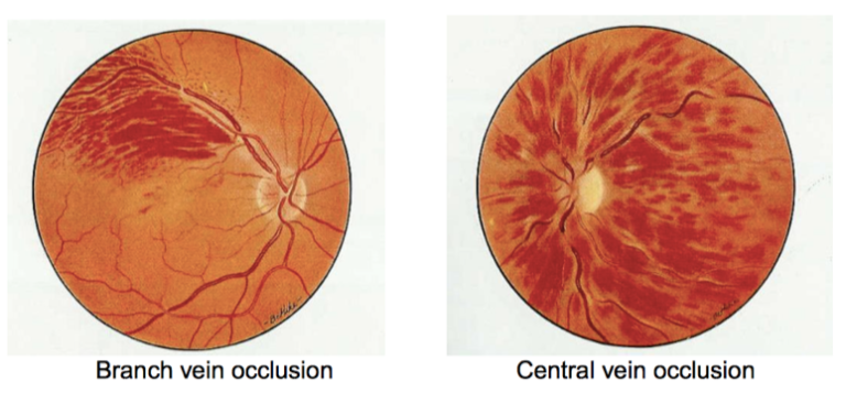 Retinal Vein Occlusion (Stroke in the Eye): Causes, Symptoms, and Treatment